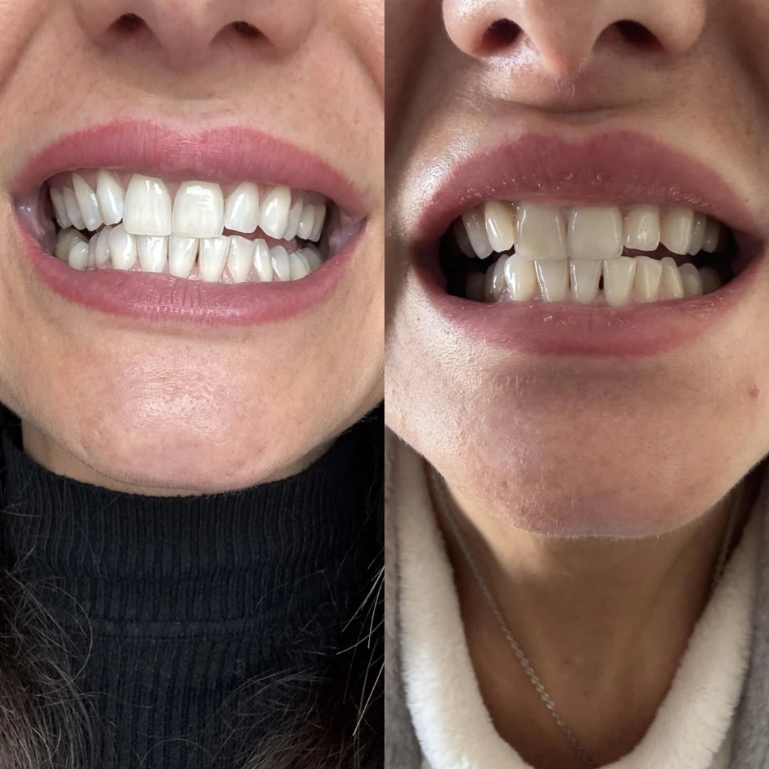 Kit sbiancante con tecnologia SmileNow®
